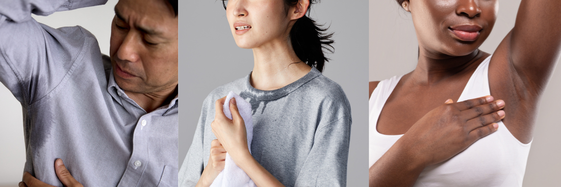 Hyperhidrosis, a Shared Struggle: Excessive Sweating Worldwide in Numbers